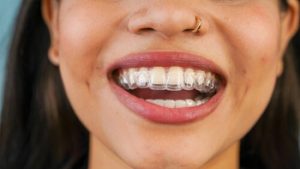 Is Invisalign Worth It wear Is Invisalign Worth It wear