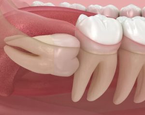 Can Wisdom Teeth Cause Ear and Throat Pain impacted Can Wisdom Teeth Cause Ear and Throat Pain impacted