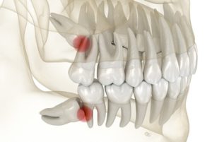 Can Wisdom Teeth Cause Ear and Throat Pain swelling Can Wisdom Teeth Cause Ear and Throat Pain swelling