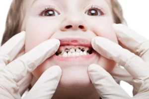 A close-up of a child's mouth showing signs of tooth decay, the dental issues to emphasize the importance of pediatric oral health