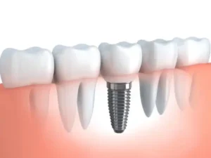 Illustration of a dental implant in a gum line