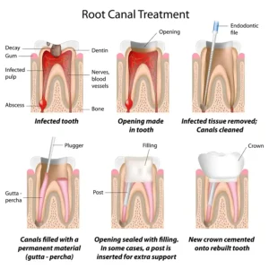 Diagram illustrating the stages of root canal treatment