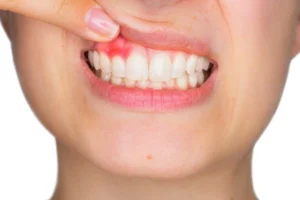 Close-up of a person lifting their upper lip to reveal swollen