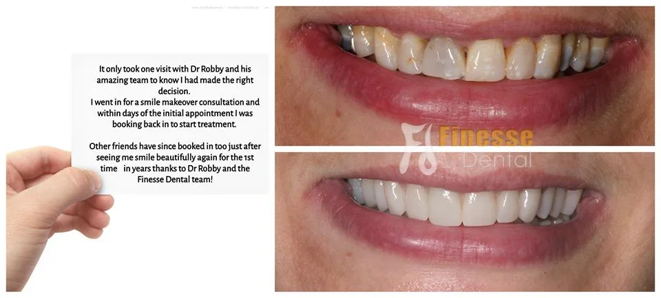 Patient-Review-1 A testimonial from the patient describes satisfaction with dental services and two close-up images show teeth before and after a smile makeover