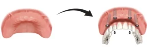 Illustration of gum tissue before and after dental implants with prosthetic teeth