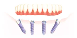 Illustration showing a set of dentures above four dental implants aligned in the jaw
