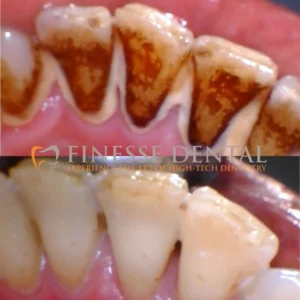 Close-up of teeth showing tartar buildup before and after cleaning