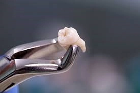 Extraction-Aftercare-Sydney-teeth A tooth held by shiny silver dental forceps