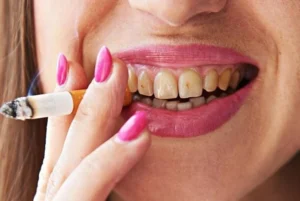 Close-up of a woman holding a cigarette and her teeth appear stained