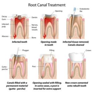 Diagram illustrating root canal treatment. Six stages show infected tooth