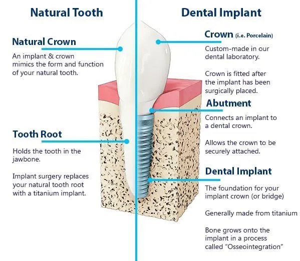 implants-illustration Diagram comparing a natural tooth and a dental implant