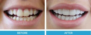 Side-by-side comparison of teeth before and after result