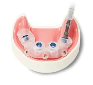 Dental implant surgical guide on a pink gum model, featuring transparent cylinders to align implants. A drill is inserted, showcasing precision in dentistry.