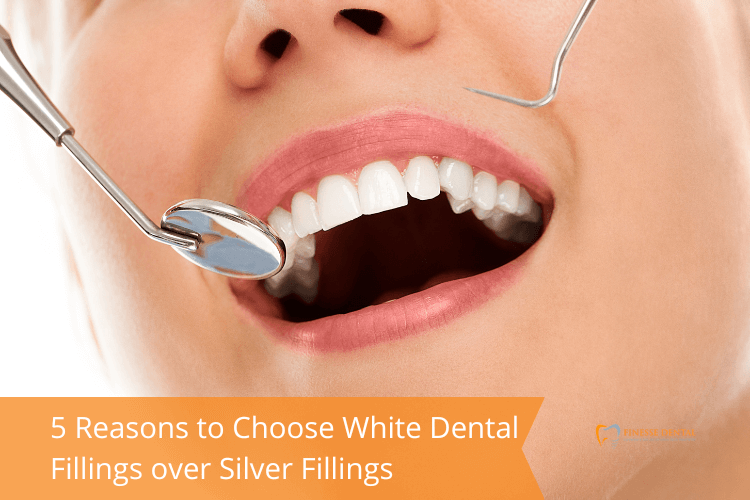 5 Reasons to Choose White Dental Fillings over Silver Fillings