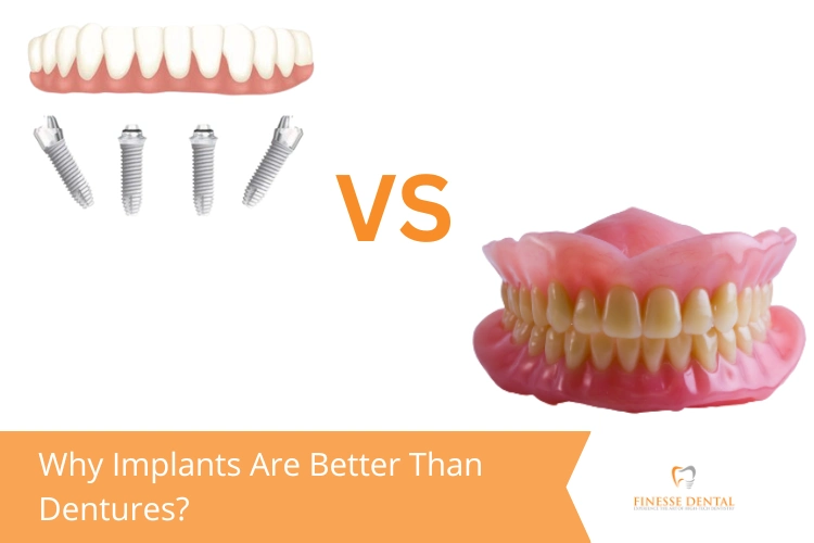 Image comparing dental implants and dentures. On the left, four implants and an upper bridge are shown, and on the right, a full set of dentures.