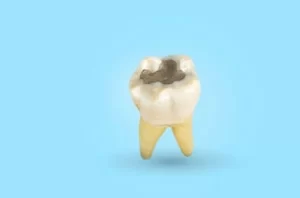 What Does a Tooth Cavity Look Like decay What Does a Tooth Cavity Look Like decay