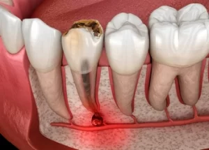 illustration of a Tiny Black Spot on Tooth illustration of a Tiny Black Spot on Tooth
