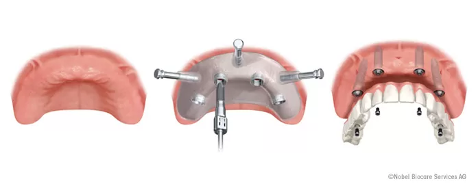 all-on-4-dental-implants-works