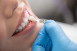 common concerns applying veneer dentist stanhope gardens