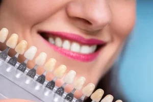 A close-up of a patient’s bright smile next to a dental shade guide, illustrating the precise color-matching process used when opting for custom composite veneers