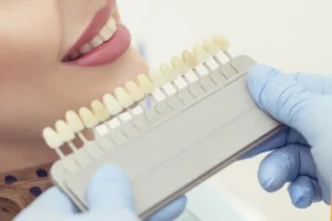 A dentist in blue gloves using a shade guide to match a patient’s tooth color, providing an essential step in the veneer teeth guide to ensure a natural look and a smart investment.