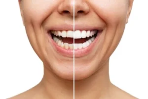 Smiling person's close-up with split image: left shows discolored teeth, right displays bright, white teeth. Highlights teeth whitening effects.