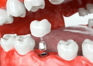 A dental implant model shows an artificial tooth being placed onto a metal post in a gum, surrounded by natural teeth, illustrating dental restoration.