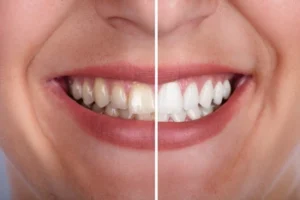 Close-up of a smiling mouth divided in half; left side shows yellowed teeth, right side shows white teeth, highlighting a before-and-after whitening effect