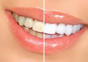 Split image showing a close-up of a smile. The left side displays yellowed teeth, while the right side shows whitened teeth, highlighting a transformation