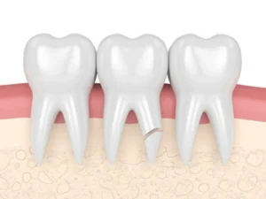 Illustration of three teeth with healthy gums, featuring one tooth with a noticeable crack