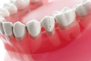 A dental model shows white teeth with a noticeable crack on one tooth. The pink gum base contrasts with the teeth, highlighting the damage