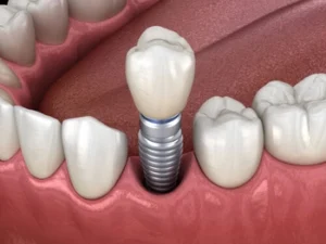 A dental implant illustration shows a metal post embedded in the gum, topped with a realistic white tooth, surrounded by natural teeth in a gum line