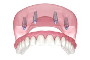 full mouth dental implants cost australia planning