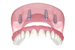 full mouth dental implants cost australia planning Illustration of a dental prosthesis with four implants. The implants are positioned in the upper jaw, supporting artificial teeth. Modern dental technology concept