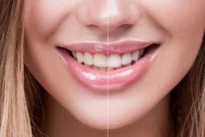 Close-up of a woman's smile, divided vertically. The left side shows yellowed teeth, while the right displays whitened teeth, illustrating a dental transformation