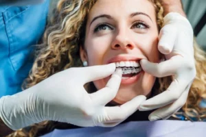 Doctor,Putting,A,Clear,Dental,Aligner,To,The,Patient,Woman Invisalign treatment process a dentist carefully fitting a clear aligner onto a patient's teeth