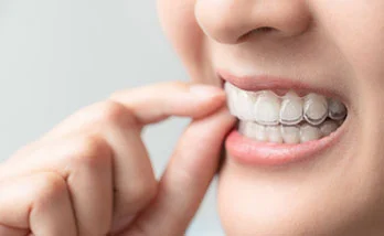 Free Consultation for Invisalign