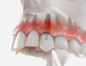 dental implant thailand illustration Illustration of a dental implant in an upper jaw, highlighting the implant beneath the gum tissue and model teeth, conveying a clinical perspective
