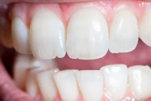 Why Does My Tooth Filling Hurt After Months teeth