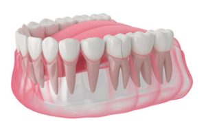How Much Does a Root Canal Cost crack
