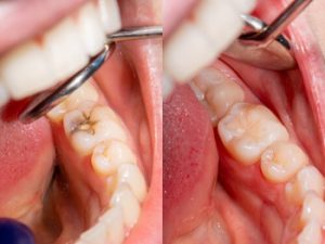 How Much Does a Root Canal Cost damage