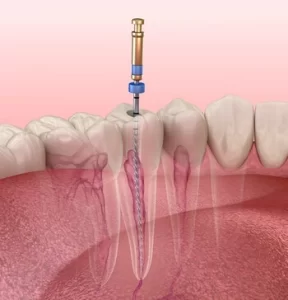 Root Canal Before and After procedure