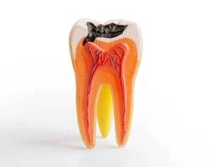 broken tooth exposed pulp root broken tooth exposed pulp root