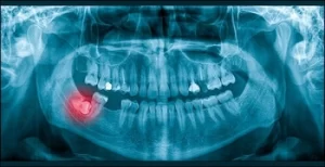 Is Wisdom Tooth Pain Normal impacted Is Wisdom Tooth Pain Normal impacted