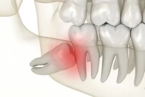 wisdom tooth pain impacted wisdom tooth pain impacted