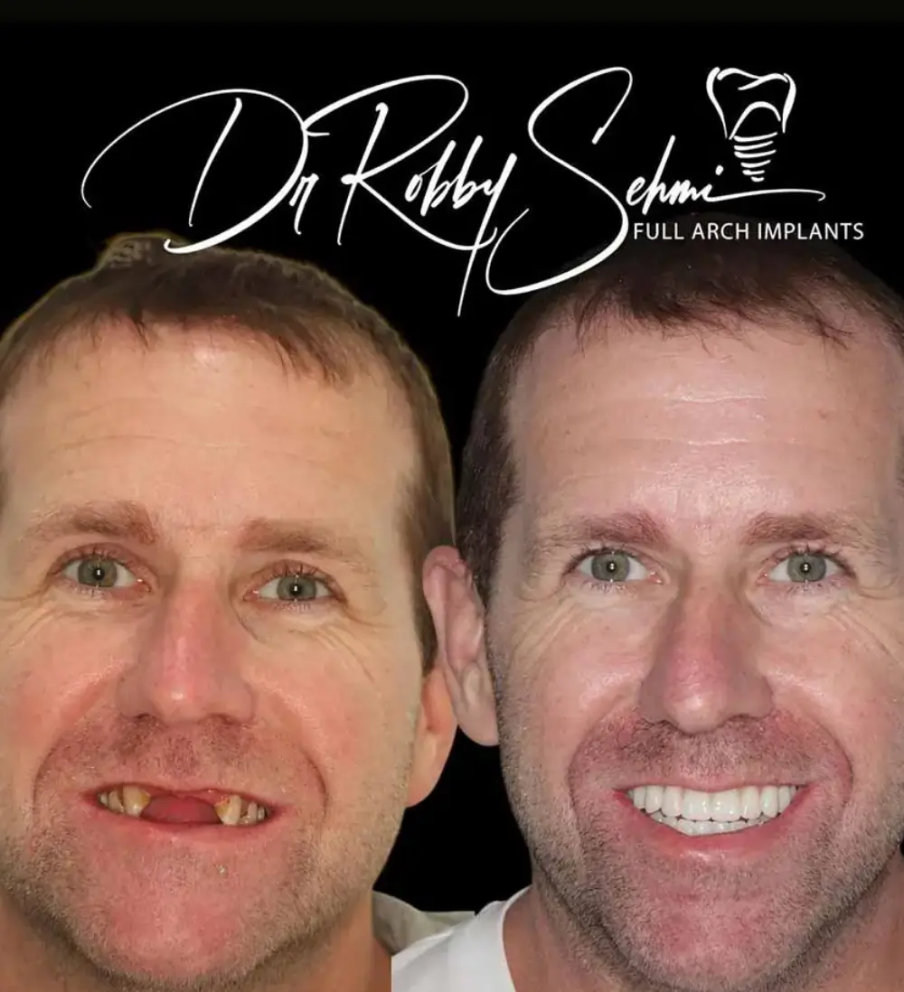 Finess Dental Implants Case 10