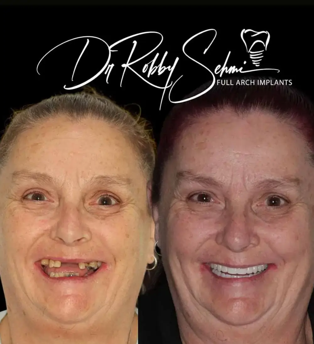 Finess Dental Implants Case 12