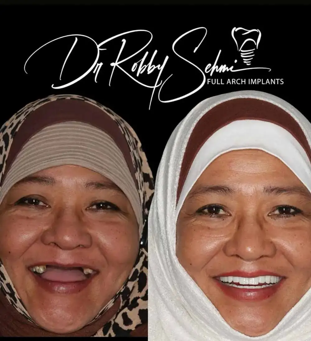 Finess Dental Implants Case 3 1 