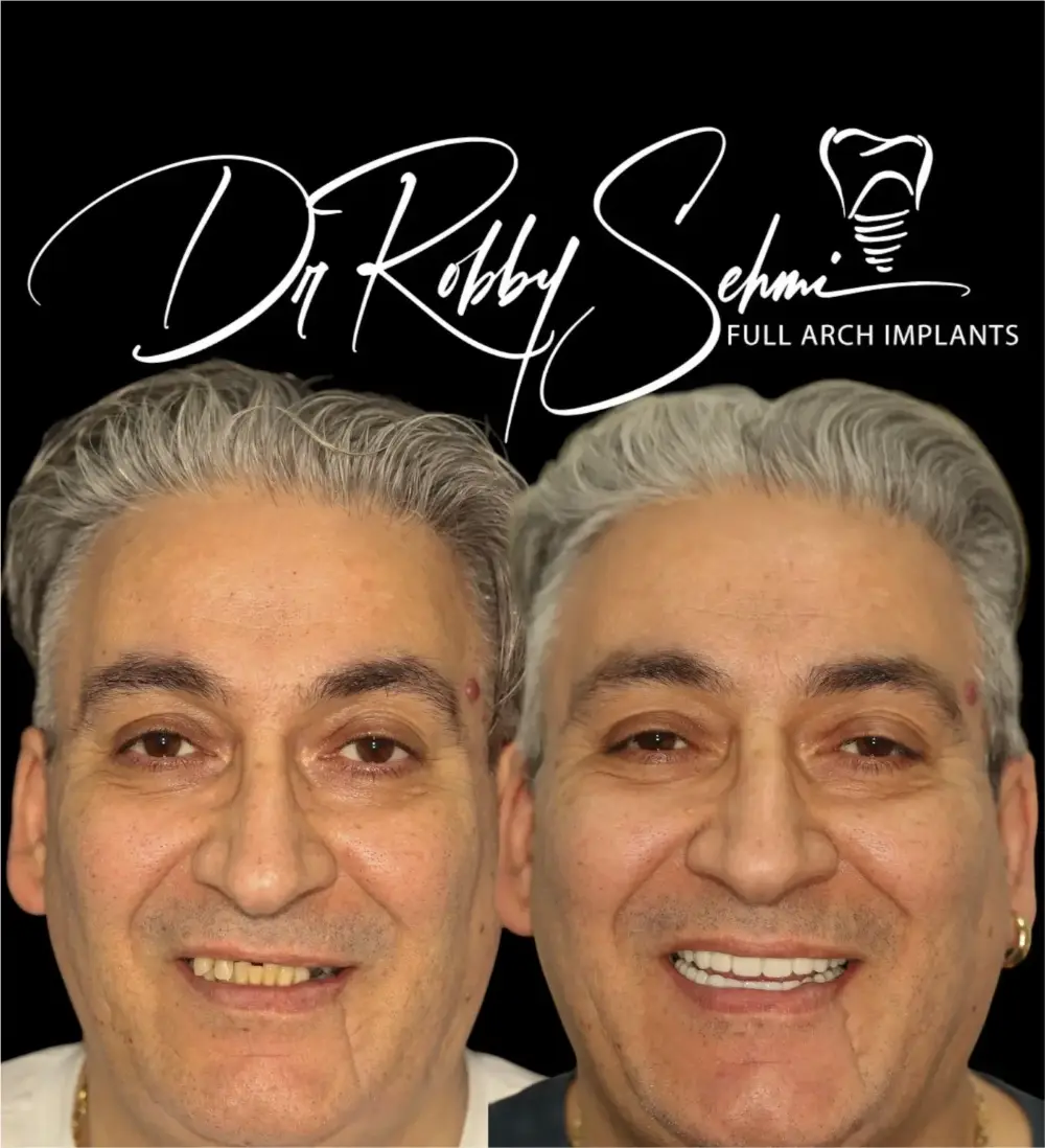 Finesse Dental Dental Implants Case 11