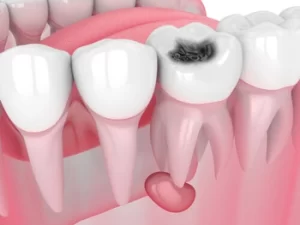 Root Canal Recovery Time infection Root Canal Recovery Time infection
